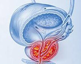 Inflamación da próstata con prostatite