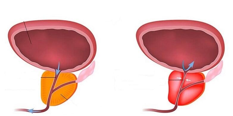 Próstata saudable e inflamada con prostatite
