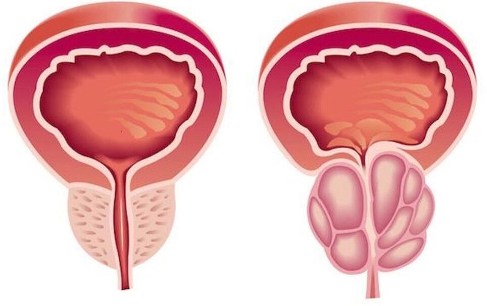 próstata sa e inflamada con prostatite